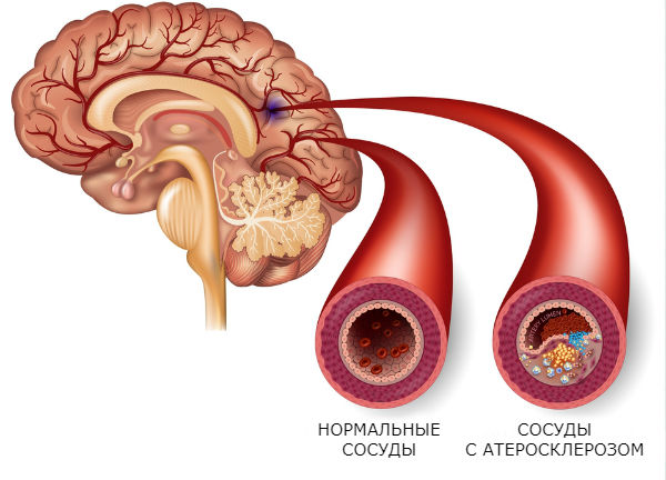 Заболевания сосудов головного мозга и шеи: лечение в Херсоне